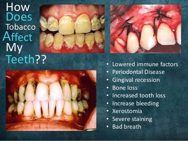 how does tobacco affect teeth Oral Consequences of Smoking Smokeless Tobacco effects on Dental